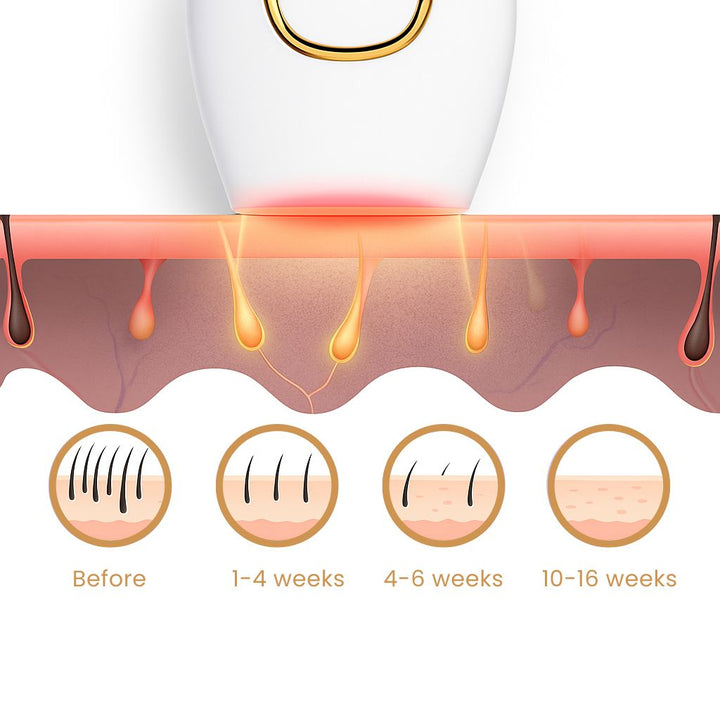IPL Laser Hair Removal Device